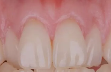 Cấy Gh&eacute;p Implant Thực Tế 2