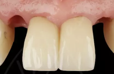 Cấy Gh&eacute;p Implant Thực Tế