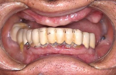 H&igrave;nh ảnh thực tế trước v&agrave; sau khi cấy implant