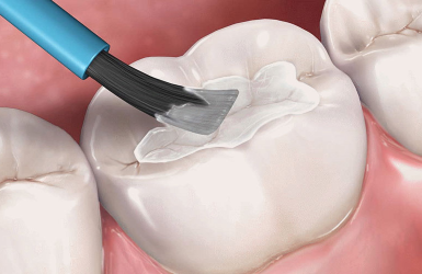 Trám Sealant Phòng Ngừa Sâu Răng
