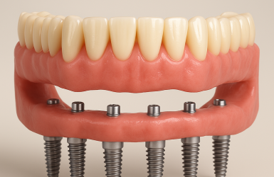 Cấy Ghép Implant Toàn Hàm