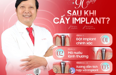 90 NG&Agrave;Y SAU CẤY IMPLANT C&Oacute; G&Igrave; XẢY RA?