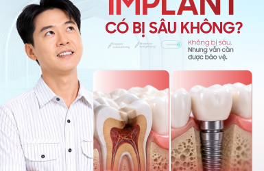 IMPLANT C&Oacute; BỊ S&Acirc;U KH&Ocirc;NG? HIỂU Đ&Uacute;NG ĐỂ BẢO VỆ IMPLANT L&Acirc;U D&Agrave;I