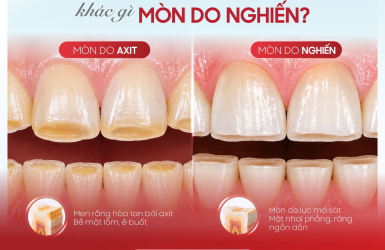 M&ograve;n răng do axit v&agrave; nghiến răng: C&aacute;ch ph&acirc;n biệt