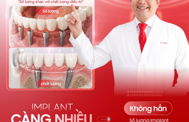 Implant c&agrave;ng nhiều trụ c&agrave;ng tốt?