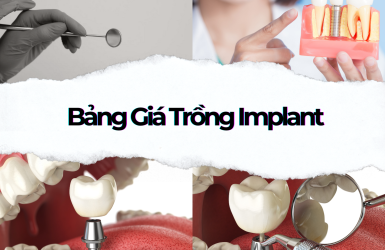 Trồng Răng Implant | Quy Trình & Bảng Giá Cấy Implant 2025