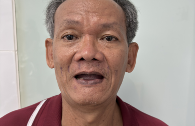 Cấy Gh&eacute;p Implant Thực Tế 4