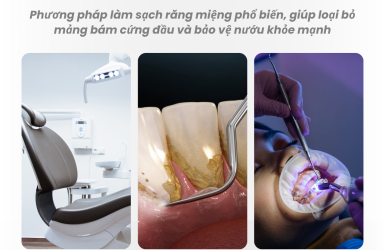 Cạo Vôi Răng Uy Tín An Toàn Tại Quận 5 TP.HCM