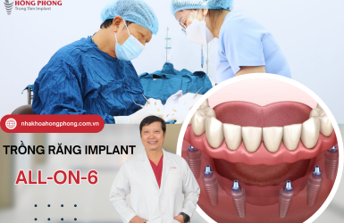 [Cập Nhật] Chi Phí Trồng Răng Implant All On 6 Bao Nhiêu Tiền?