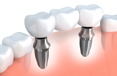 Cấy Ghép Implant Vài Răng