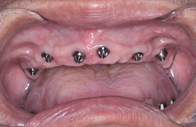 H&igrave;nh ảnh trước v&agrave; sau khi cấy implant ALL ON 6