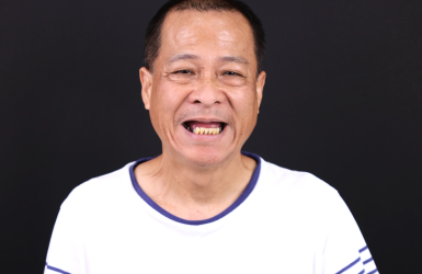 H&igrave;nh ảnh trước v&agrave; sau khi cấy implant ALL ON 6