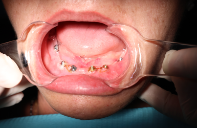 Cấy Gh&eacute;p Implant Thực Tế 2 - Trần Thị Nhung