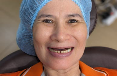 Cấy Gh&eacute;p Implant Thực Tế 7