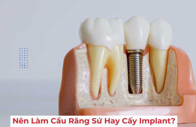 Cầu Răng Sứ & Cấy Ghép Implant - Nên Lựa Chọn Phương Pháp Nào?