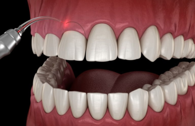 Điều Trị Cười Hở Lợi