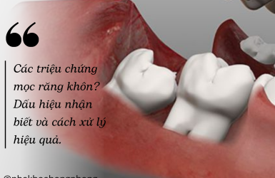 Các Triệu Chứng Mọc Răng Khôn: Dấu Hiệu Nhận Biết Và Cách Xử Lý Hiệu Quả