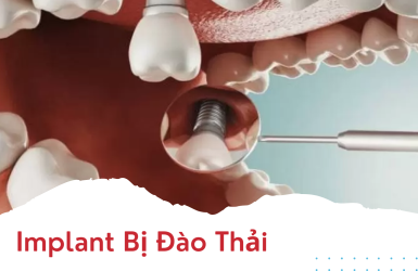 Implant Bị Đào Thải: Nguyên Nhân, Dấu Hiệu và Giải Pháp Khắc Phục Hiệu Quả
