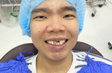 Cấy Gh&eacute;p Implant Thực Tế 3
