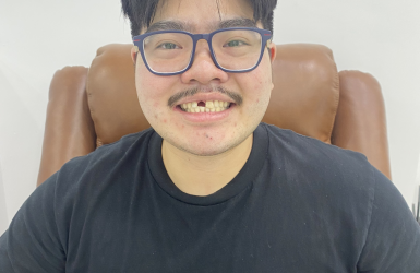 Cấy Gh&eacute;p Implant Thực Tế 6