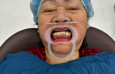 Cấy Gh&eacute;p Implant Thực Tế 8