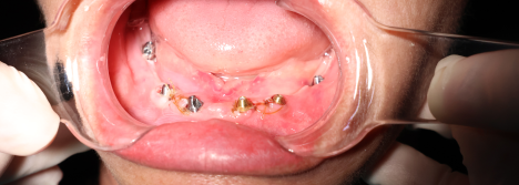 Cấy Ghép Implant Thực Tế 2 - Trần Thị Nhung