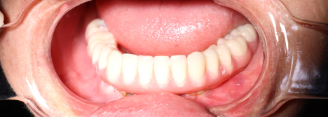 Cấy Ghép Implant Thực Tế 2 - Trần Thị Nhung