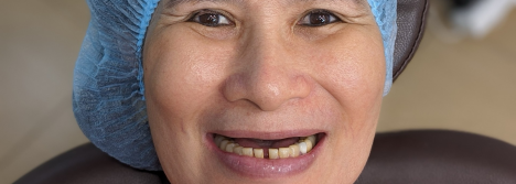 Cấy Ghép Implant Thực Tế 7