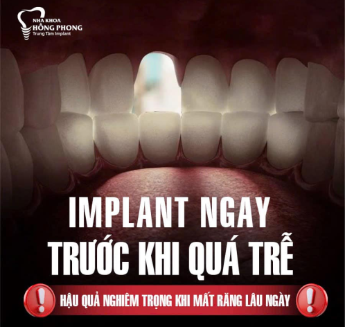 Hậu Quả Nghiêm Trọng Khi Mất Răng Lâu Ngày