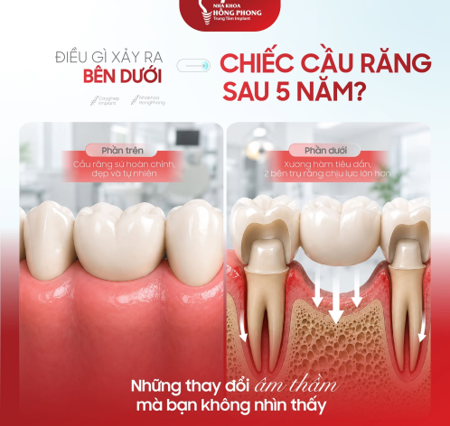 ĐIỀU G&Igrave; XẢY RA B&Ecirc;N DƯỚI CHIẾC CẦU RĂNG SAU 5 NĂM?