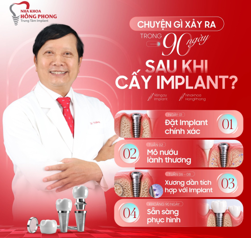 90 NG&Agrave;Y SAU CẤY IMPLANT C&Oacute; G&Igrave; XẢY RA?