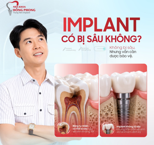 IMPLANT C&Oacute; BỊ S&Acirc;U KH&Ocirc;NG? HIỂU Đ&Uacute;NG ĐỂ BẢO VỆ IMPLANT L&Acirc;U D&Agrave;I