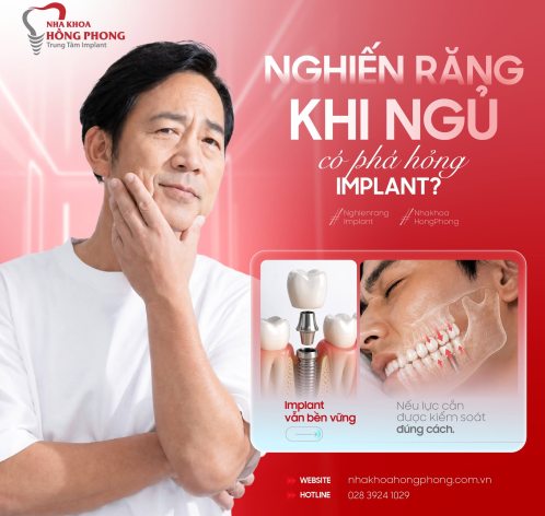 NGHIẾN RĂNG KHI NGỦ C&Oacute; PH&Aacute; HỎNG IMPLANT?