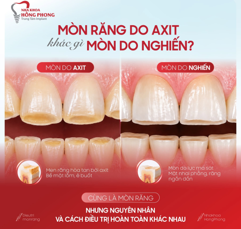 M&ograve;n răng do axit v&agrave; nghiến răng: C&aacute;ch ph&acirc;n biệt