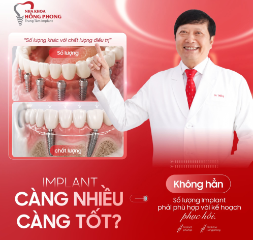 Implant c&agrave;ng nhiều trụ c&agrave;ng tốt?