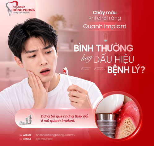 Chảy m&aacute;u quanh Implant: B&igrave;nh thường hay bệnh l&yacute;?