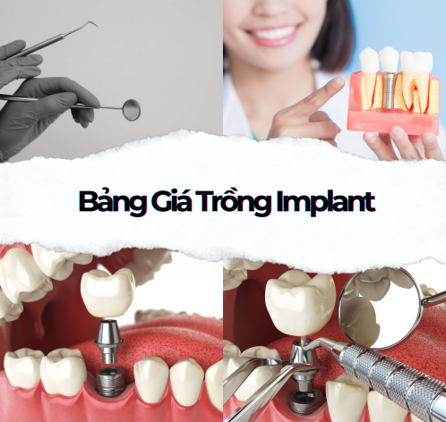 Trồng Răng Implant | Quy Trình & Bảng Giá Cấy Implant 2025