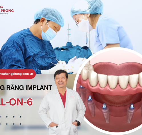 [Cập Nhật] Chi Phí Trồng Răng Implant All On 6 Bao Nhiêu Tiền?