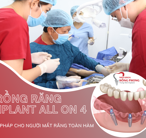 Implant All On 4 Giá Bao Nhiêu?【Phục Hình Toàn Diện】