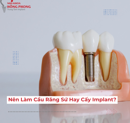 Cầu Răng Sứ & Cấy Ghép Implant - Nên Lựa Chọn Phương Pháp Nào?