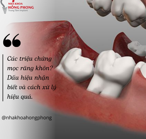 Các Triệu Chứng Mọc Răng Khôn: Dấu Hiệu Nhận Biết Và Cách Xử Lý Hiệu Quả