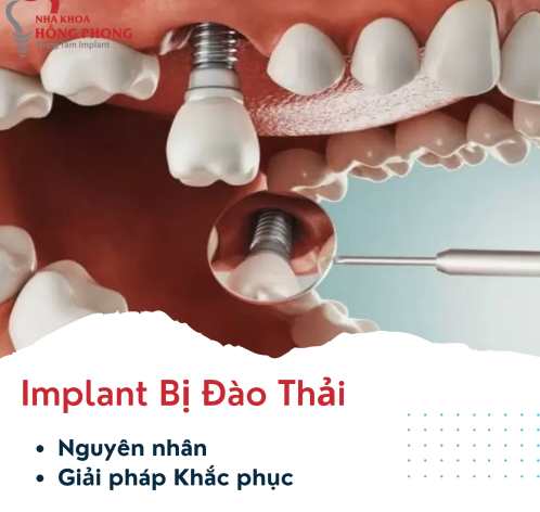 Implant Bị Đào Thải: Nguyên Nhân, Dấu Hiệu và Giải Pháp Khắc Phục Hiệu Quả