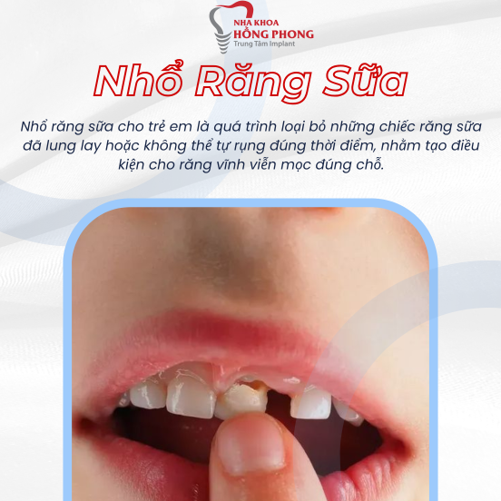 NKTE-Nhổ Răng Sữa