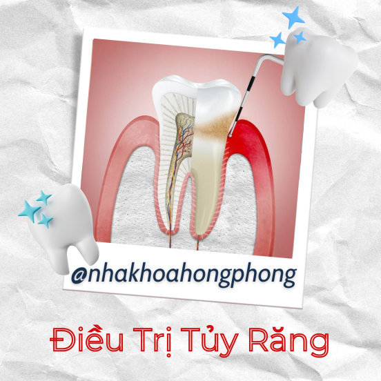 NKTQ - Điều Trị Tủy