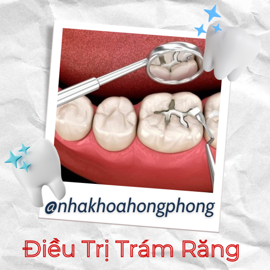 NKTQ - Trám Răng