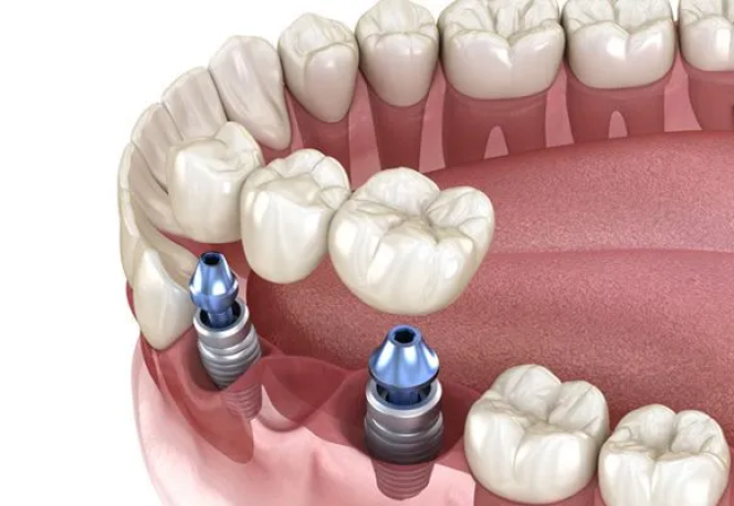 Trường Hợp Thực Hiện Cấy Ghép Implant Vài Răng?