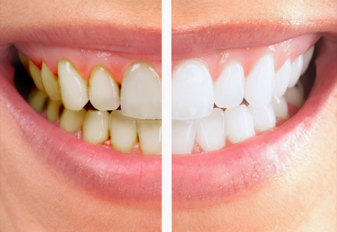 Trường Hợp Dùng Phương Pháp Cạo Vôi Răng, Đánh Bóng Răng