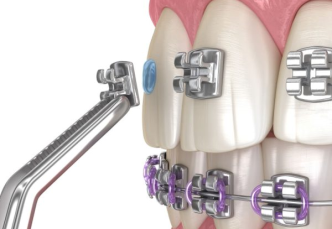 Trường Hợp Sử Dụng Phương Pháp Niềng Răng Mắc Cài Sứ