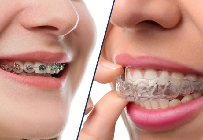 Khi Nào Nên Đưa Trẻ Đi Chỉnh Nha Sớm?