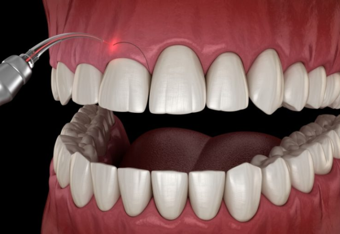 Cười Hở Lợi Có Thể Từ Nhiều Nguyên Nhân